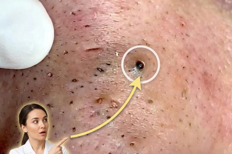 The Relationship Between Puberty And Acne Development
