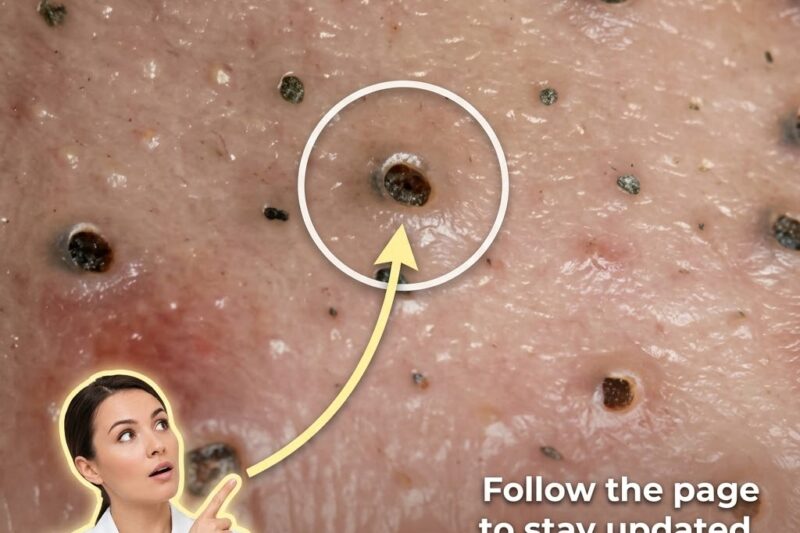 Why Adult Acne Behaves Differently Than Teenage Acne