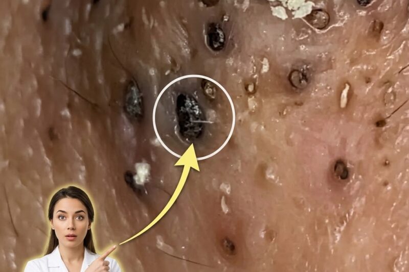 How Environmental Pollution May Worsen Acne