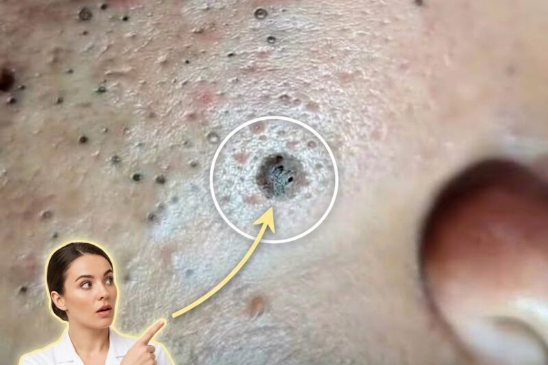How Acne Is Not Simply Caused By Dirty Skin