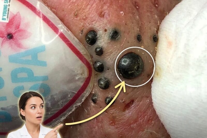 How Chemical Exfoliation Helps With Pore Congestion
