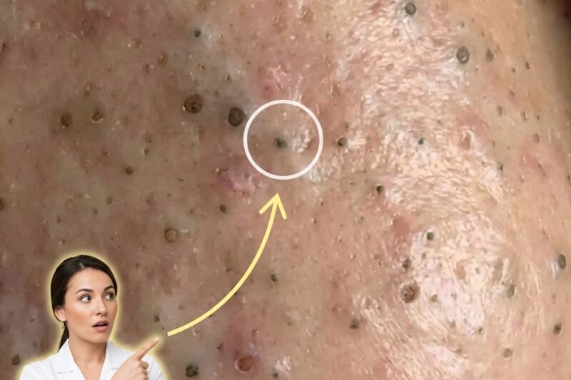 The Progression From Microcomedones To Inflamed Acne