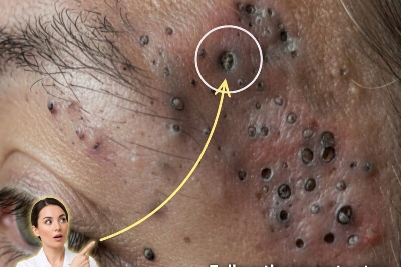 How Oxidation Affects The Appearance Of Blackheads