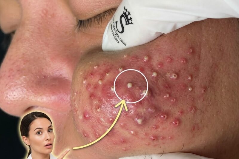 Why Retinoids Can Initially Cause Irritation