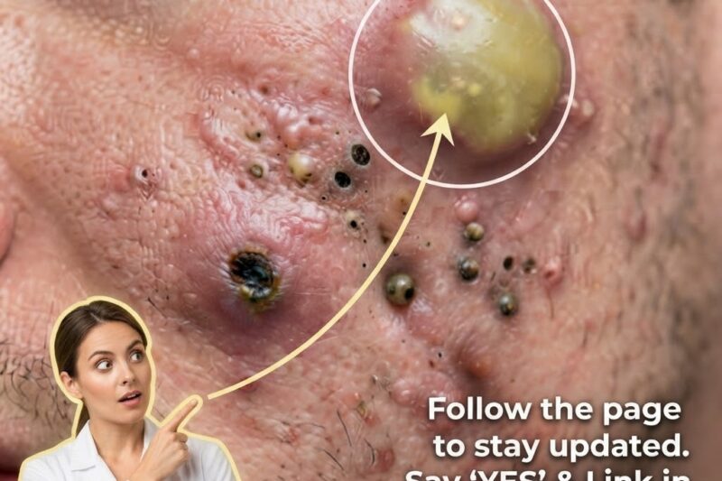 How Benzoyl Peroxide Targets Acne-Causing Bacteria
