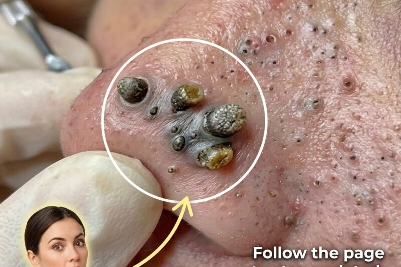 Why Barrier Repair Matters In Acne Management