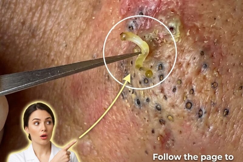 The Difference Between Comedonal And Inflammatory Acne