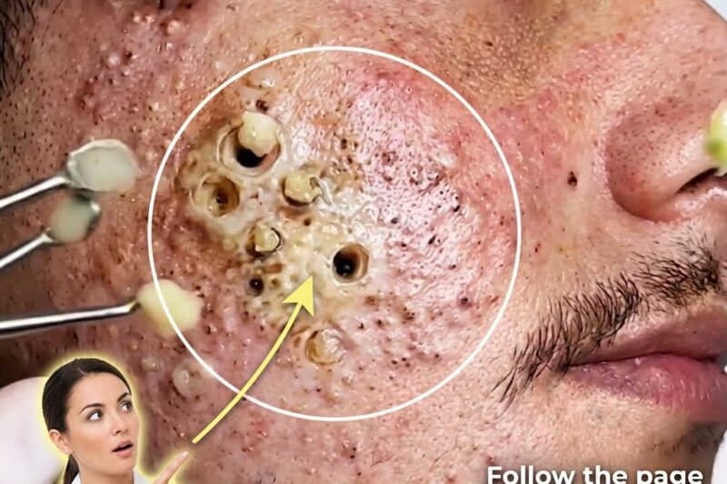 Why Sensitive Skin Can Still Be Acne-Prone