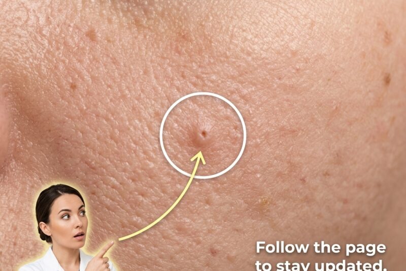 How Skin Healing Works After Inflammatory Breakouts and the Role of Ingredient
