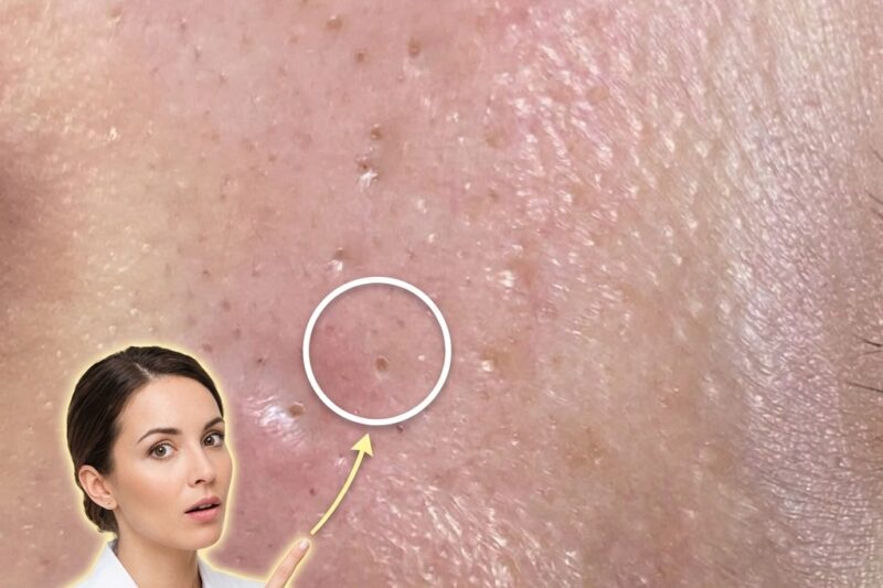 Understanding How Cutibacterium Acnes and Ingredient Interactions Drive Inflammatory Acne