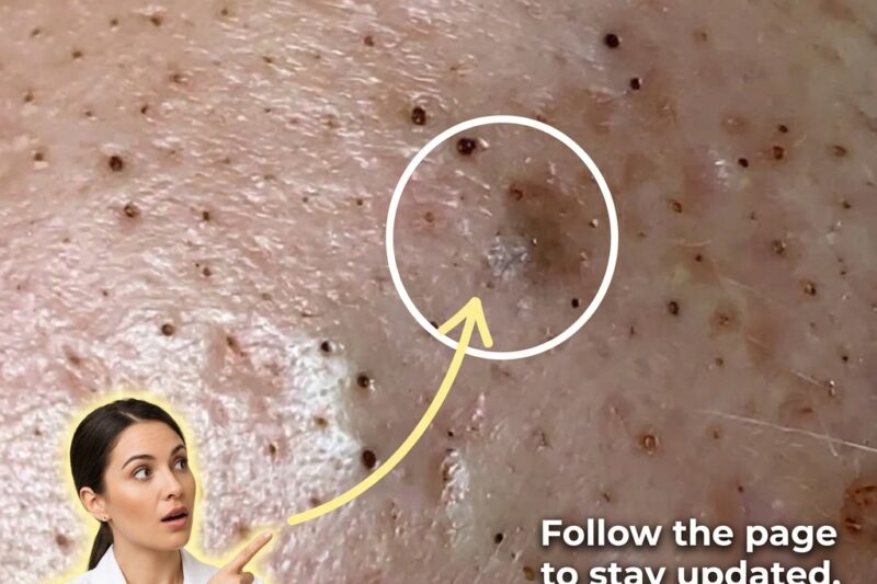 Understanding the Biological Mechanisms Behind Delayed Acne Lesion Recovery