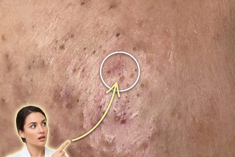Understanding the Biological Progression From Microcomedones to Inflamed Acne