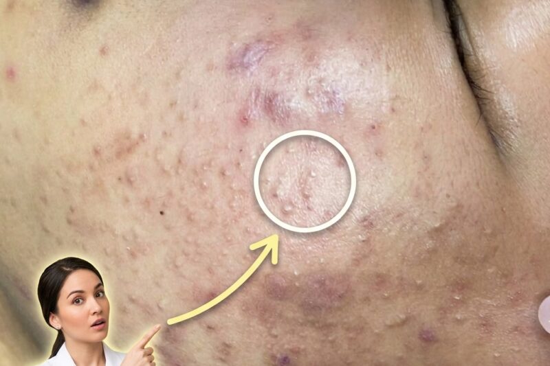 Understanding the Cellular Link Between Acne Lesions and Post-Inflammatory Hyperpigmentation