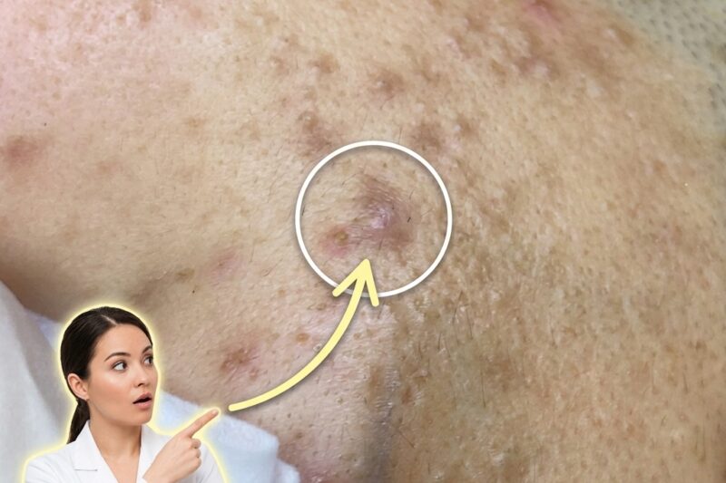 Understanding the Distinct Biology of Adult Acne Versus Teenage Breakouts