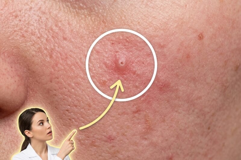 Understanding the Distinction Between Acne Scars and Post-Acne Marks