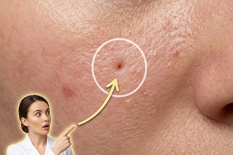 Understanding the Importance of Early Intervention in Preventing Long-Term Acne Marks